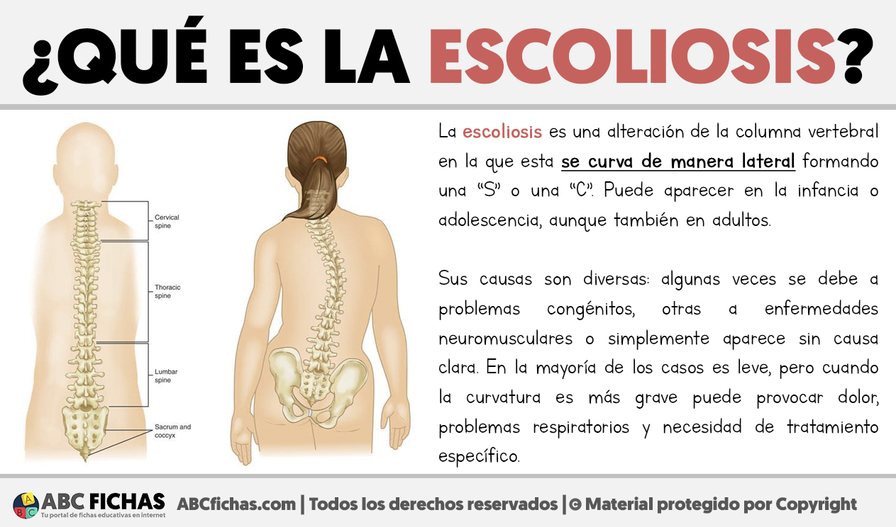 Que es la escoliosis